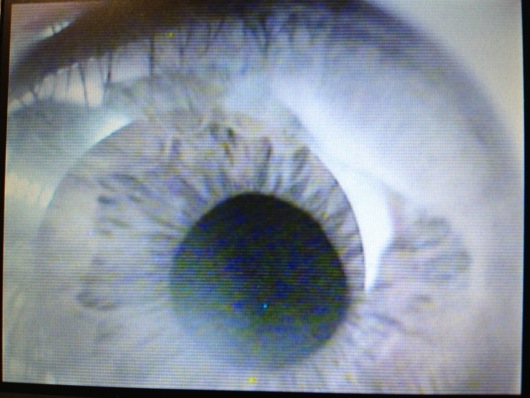 My Eyeball